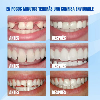 Resina Dental Moldeable 💫