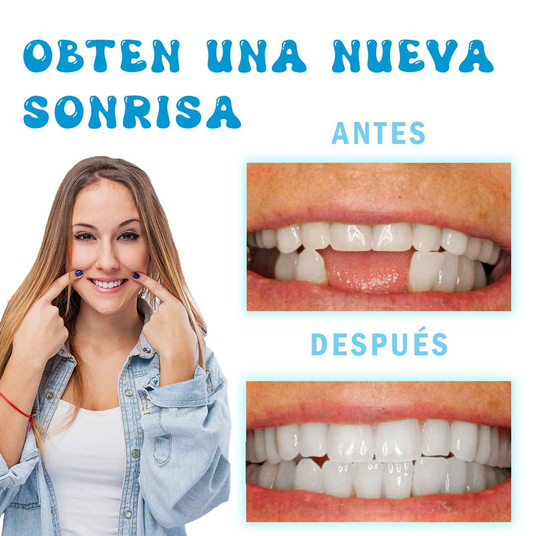 Resina Dental Moldeable 💫